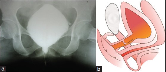 Figure 1: (a) VCUG showing obliterative stricture of mid-urethra with false passage. (b) Diagrammatic representation showing obliterative stricture of mid-urethra with false passage