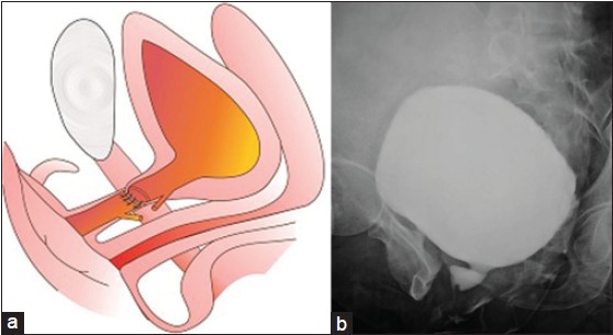 Figure 3: (a) Diagrammatic representation showing completed anastomosis between normal urethral lumens avoiding false passage. (b) Post-operative VCUG showing anastomosis between normal urethral lumens avoiding false passage
