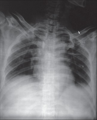 Figure 1: Chest X-ray showing guide wire of catheter had entered in the inferior vena cava (IVC) via the right internal jugular vein