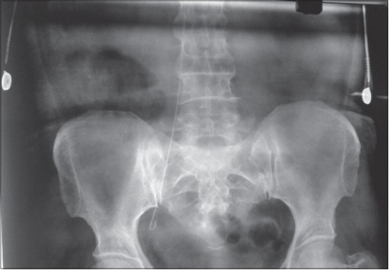 Figure 2: X-ray pelvis showing guide wire catheter had remained in the right iliac vein at the point of bifurcation into the internal and external iliac veins