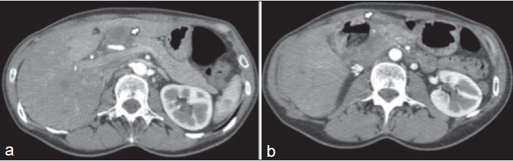 Figure 1: Pre-operative abdominal computed tomography showing a mass in the head of the pancreas (white arrow) (a) with central necrosis (white arrow) (b)
