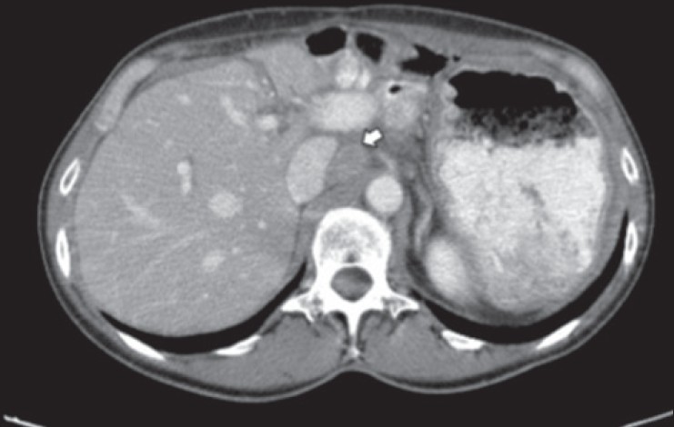 Figure 2: Abdominal computed tomography showing para-aortic lymph node recurrence (white arrow)