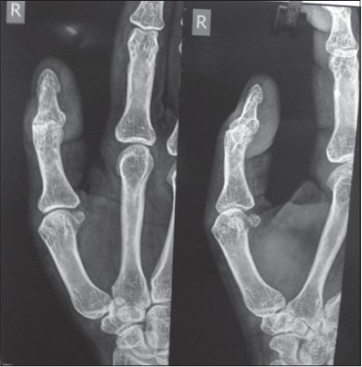Figure 1: Radiograph-anteropsterior and lateral view