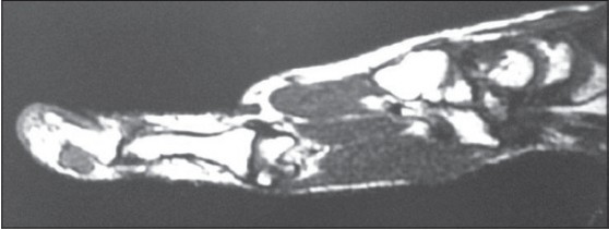 Figure 2: T2 weighted Magnetic resonance imaging showing swelling arising from tendon insertion
