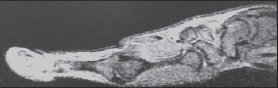 Figure 3: T1 weighted Magnetic resonance imaging showing swelling arising from tendon insertion