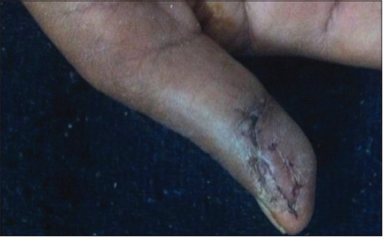 Figure 6: Clinical photographs after suture removal