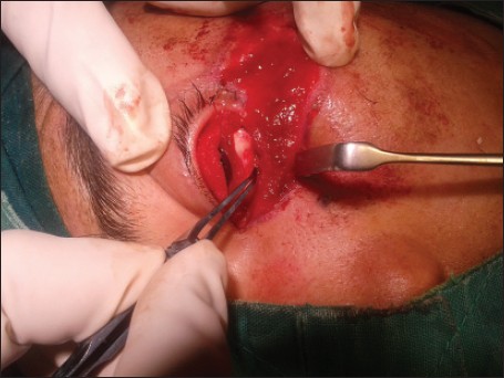 Figure 2: Conchal cartilage pocketed within orbicularis fi bers