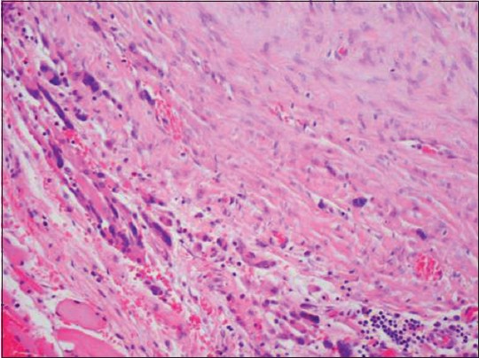 Figure 1: Medium power: Spindle cells with classic myofibroblastic cells within collagenous to myxoid stroma and associated inflammatory cells. No atypical mitosis or anaplastic elements are seen. (Note: Proliferation of spindle cells with blend nuclei and fascicular arrangement seen)