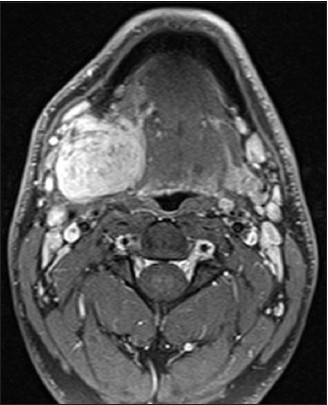 Figure 2: Axial cut of MRI scan showing large mass in the right submandibular region, indenting and pushing the tongue off midline