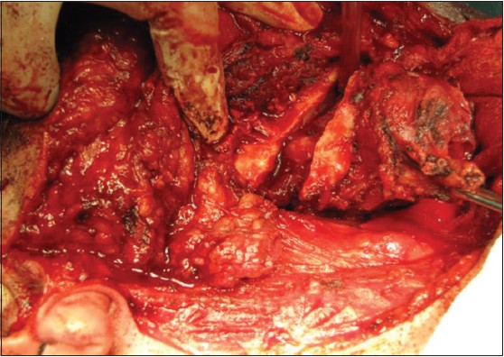 Figure 4: Intraoperative photograph showing tumor attachment to the mandible. Segmental mandibulectomy was carried out sparing the inferior alveolar nerve