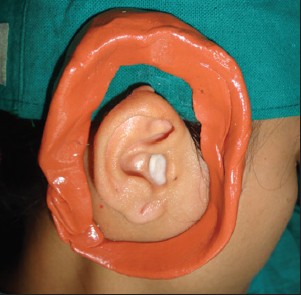Figure 1: Impression compound beading around the right auricle with blocked meatus
