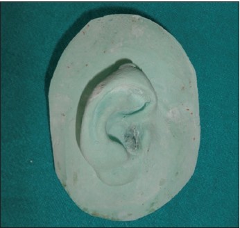 Figure 2: Master cast of right auricle showing keloid on helix