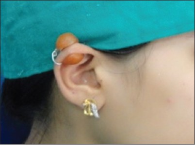 Figure 3: Custom-made pressure appliance with spring on the right ear helix