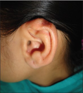 Figure 4: Post-excisional scar on the left ear helix