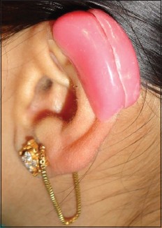 Figure 5: Prophylactic appliance on the scar on the left ear helix