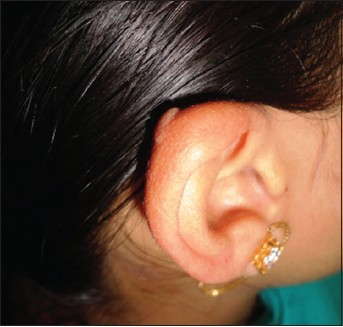Figure 7: Reduced and shrunken keloid on the right ear helix