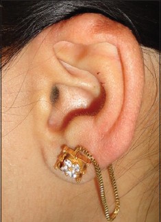 Figure 8: Healed scar on the left ear helix