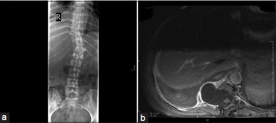 Figure 2: (a) Thoracolumbar plain radiograph; (b) chest computed tomography scan