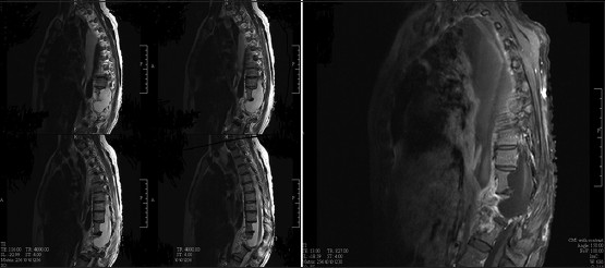 Figure 3: Thoracolumbar MRI