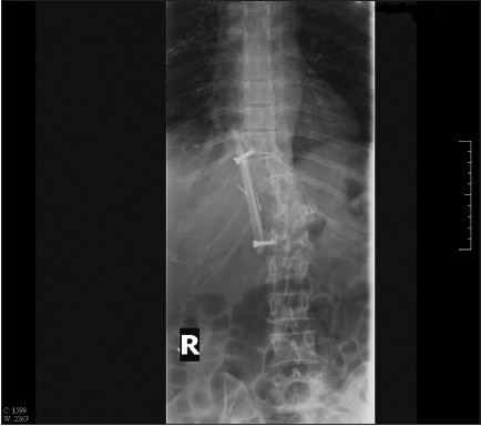 Figure 4: Postoperative thoracolumbar plain radiograph
