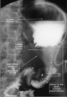 Figure 2: Water-soluble contrast swallow X-ray at POD 6