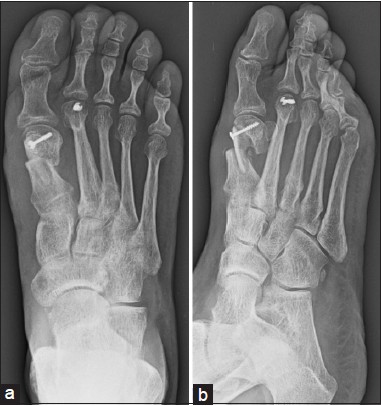 Figure 4: Plain radiographs: Postoperative anteroposterior and oblique views of the proximal peg firmly fitted into the metatarsal shaft