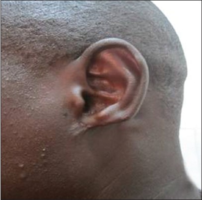 Figure 1: Pre-operative appearance of a type IIA defect of the ear lobule