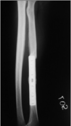 Figure 1: Peri-implant fracture at the proximal end of the plate