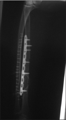 Figure 3: X-ray after removal of the original implant and application of the new implant
