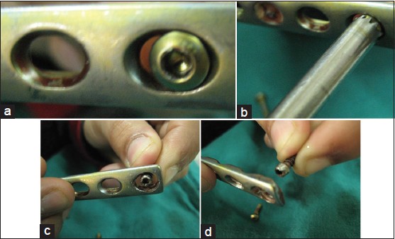 Figure 4: (a) Stripped head of a jammed screw (b) Use of high-speed stainless steel hollow mill around the head of the screw (c) Enlarged hole of the plate after grating of the metal from the periphery of the hole (d) Screw head passing through the enlarged hole
