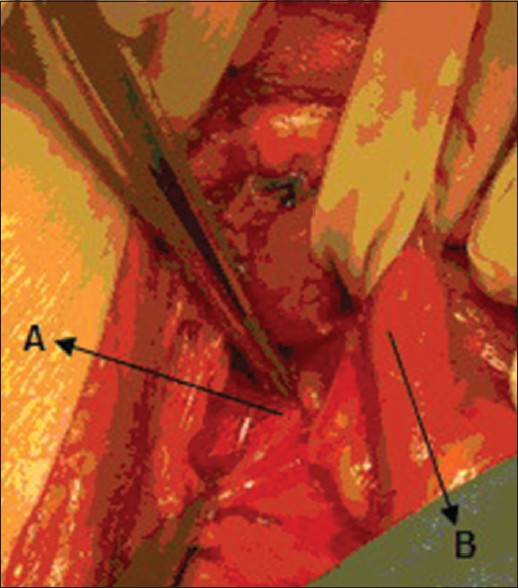 Figure 2: Intraoperative photograph showing the aberrant right subclavian artery (A) in retroesophageal position, behind the esophagus (B) which is separated by Penrose drain