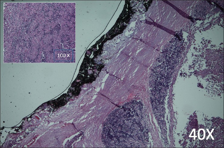 Figure 3: Photomicrograph shows encapsulated tumor with extensive necrosis with few preserved areas (H and E, ×40). High-power (inset) shows admixture of epithelial cells and small lymphocytes (H and E, ×100)