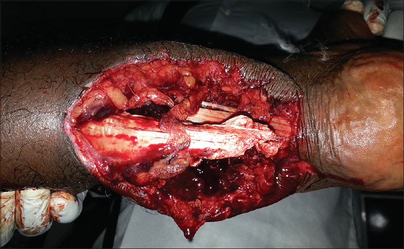 Figure 4: Preoperative picture showing exposed Achilles tendon. The cavitation effect of the gunshot damaged the sural artery