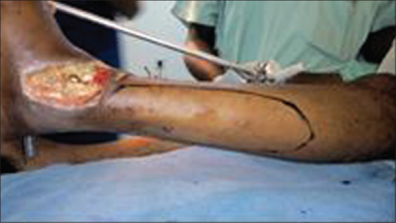 Figure 7: Preoperative planning showing the flap outline. Identified perforators were marked as x on the outline