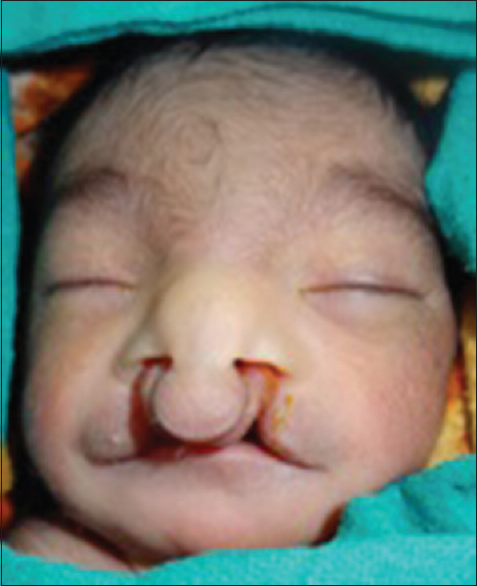 Figure 1: Extraoral view showing bilateral cleft lip