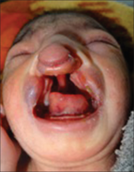 Figure 2: Intraoral view showing cleft lip and palate