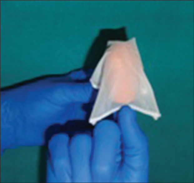 Figure 4: Gauze wrapped around the putty impression material loaded on the finger