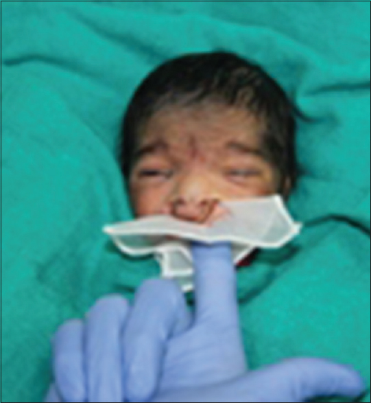 Figure 5: Maxillary impression made with functional movements by neonate