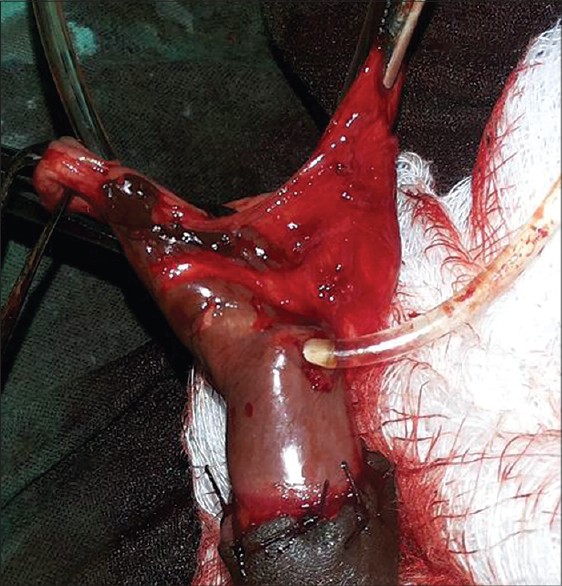 Figure 2: Congenital anterior urethral diverticulum demostrated intraop