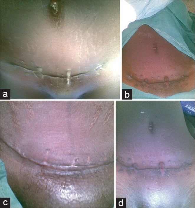 Figure 1: (a-d) Show ragged scars of Pfannenstiel incisions for the four patients