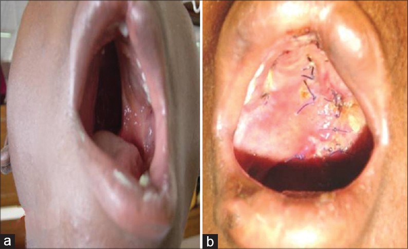 Figure 3: Complete bilateral cleft of the secondary palate (a) Pre-operative (b) Post-operative