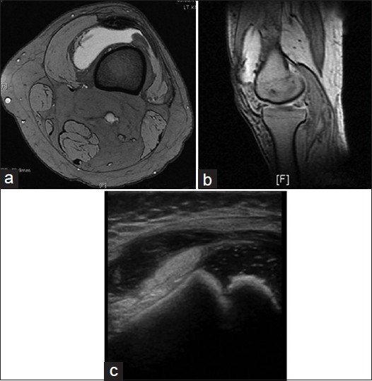Figure 1: Knee joint effusion: (a) Axial T2-weighted magnetic resonance imaging (MRI), (b) sagittal T2-weighted MRI, (c) ultrasound