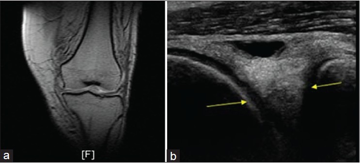 Figure 2: Medial meniscal tear: (a) Coronal T1-weighted magnetic resonance imaging, (b) ultrasound