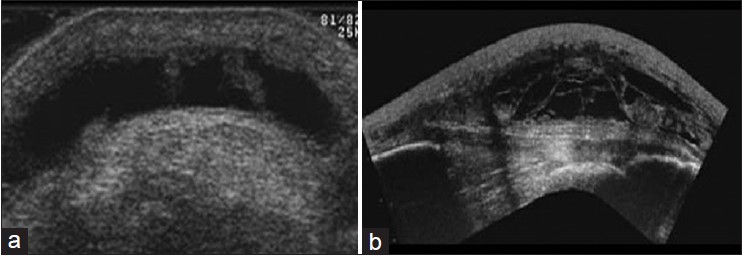 Figure 3: Ultrasound prepatellar bursitis (a) and a septal pattern (b)