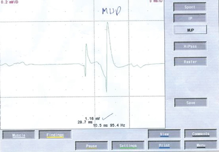 Figure 3: Electromyography showing chronic inactive denervation features