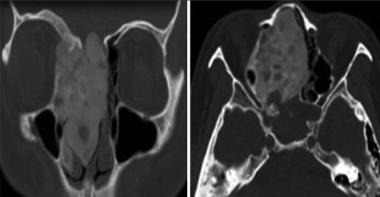 Figure 2: Axial and coronal computed tomography images demonstrate granulomatous disease in a 33-year-old female