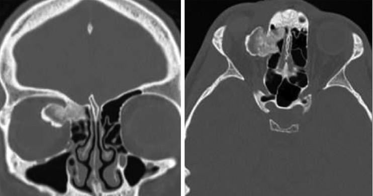 Figure 3: Axial and coronal computed tomography images demonstrate benign osteoma in a 17-year-old man