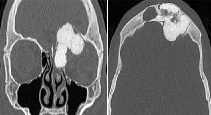 Figure 4: Axial and coronal computed tomography images demonstrate frontal sinus osteoma in a 13-year-old man