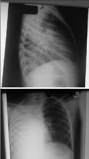 Figure 3: Chest X-ray showing opacified right hemi-thorax with mediasternal shift to the right