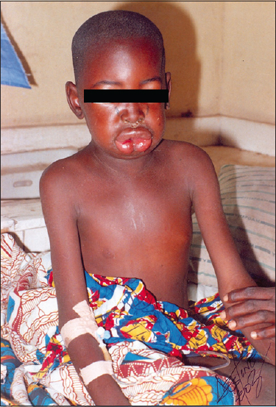 Figure 1: 10-year-old Fulani herds' boy with posterior neck viper bite and coagulopathy, severe edema of the scalp, face, and chest